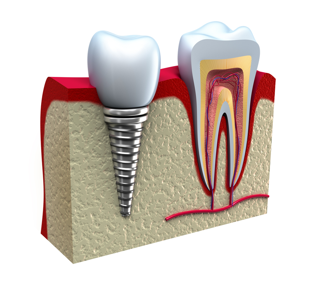 How Do Dental Implants Work?