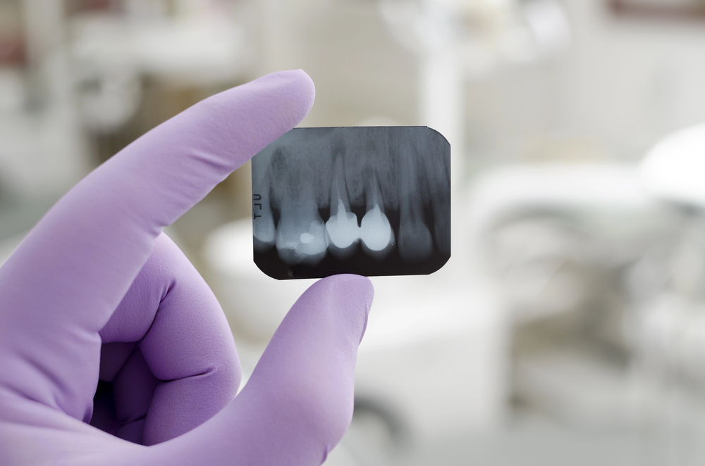 Can Dental X-rays Detect Cavities Between Teeth?